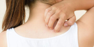 পিঠের ব্রণ থেকে মুক্তির ঘরোয়া এবং সহজ উপায়